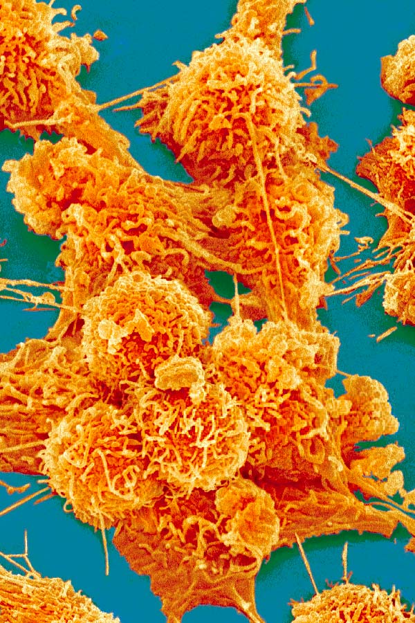 Detección precoz del cáncer